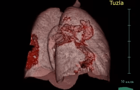 Pluća zaraženog pacijenta - Avaz